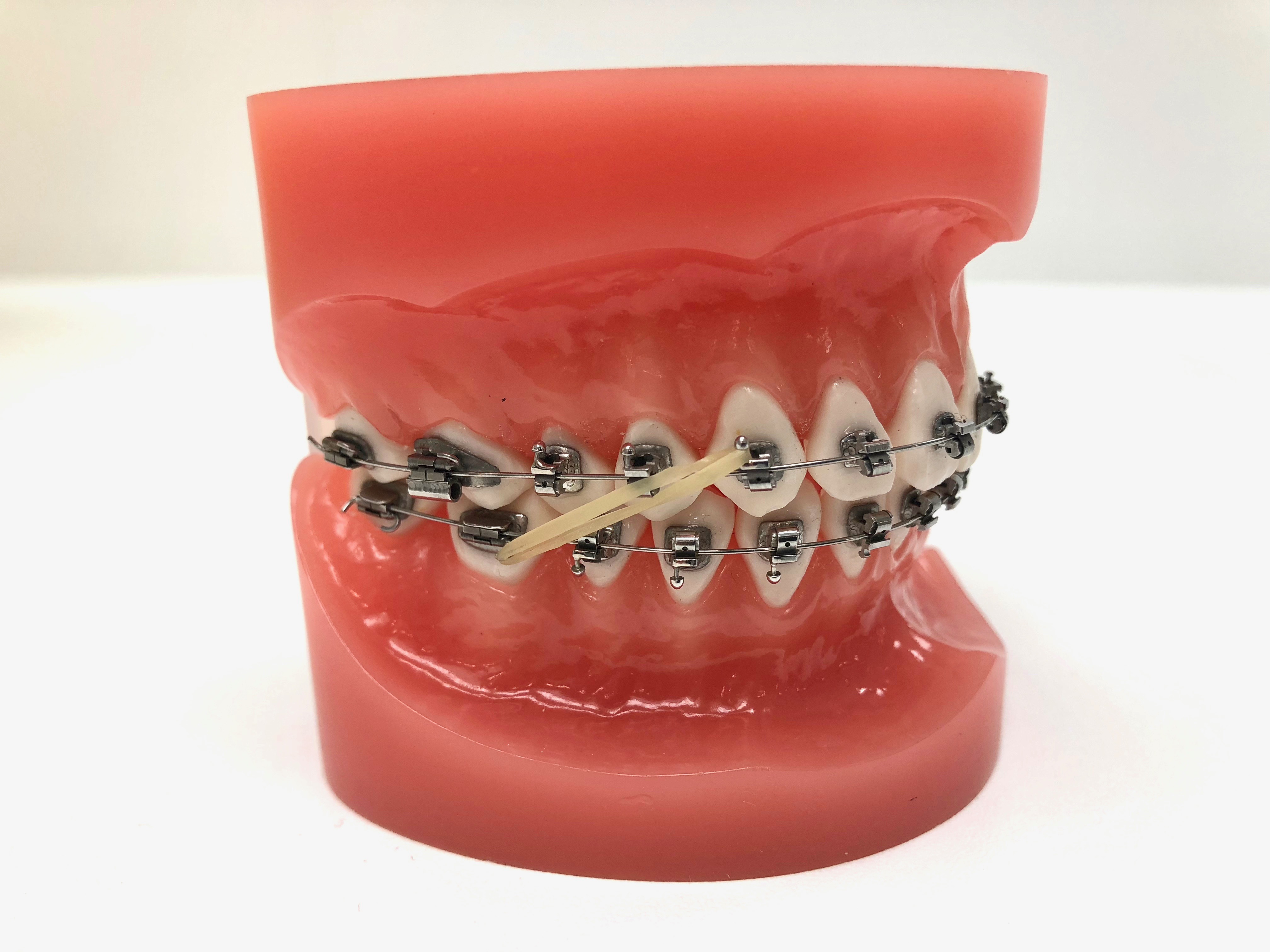 grijnzend Aanvankelijk Kaliber Elastieken - Orthodontiepraktijk Den Helder
